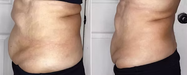 after1treatment after1treatment Ultimate Contour in Stockton, CA | The Weight Loss Center