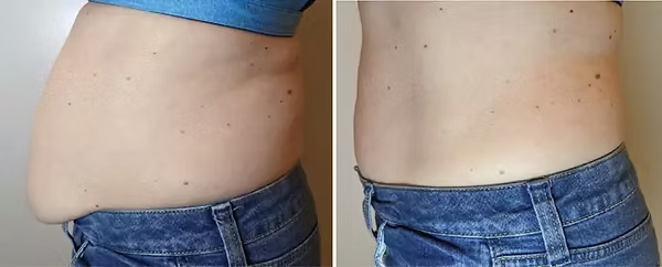 after3treatments after3treatments Ultimate Contour in Stockton, CA | The Weight Loss Center